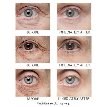 Instant Eye Lift Treatment
