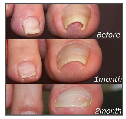 Nail Care Correction Patches